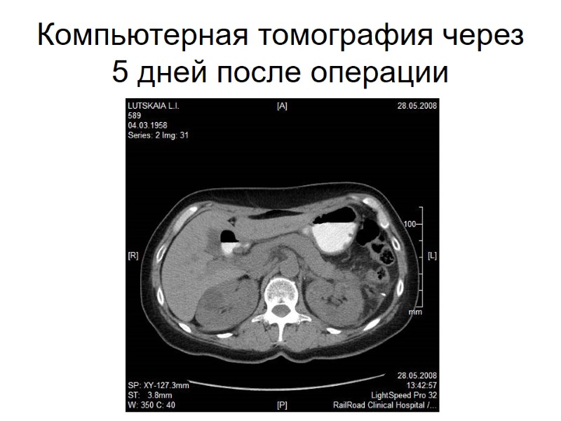 Компьютерная томография через 5 дней после операции